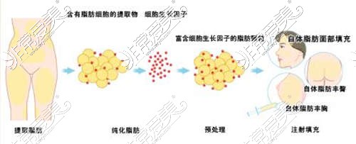 济南自体脂肪隆胸能维持多久