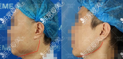 杭州连天美高俊明男性下颌角手术效果对比