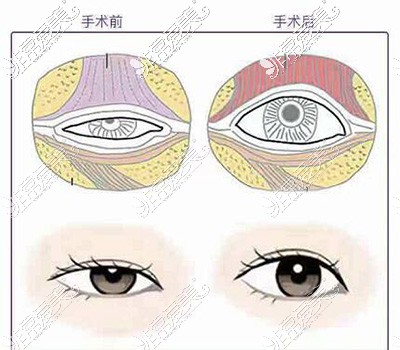 眼提肌矫正卡通图示