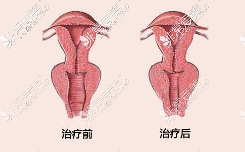 做完缩阴手术需要多久才恢复好?揭秘缩阴手术恢复期多久！