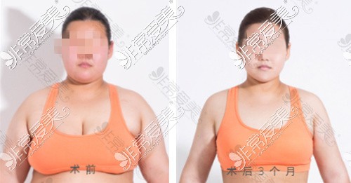 胸部太大且下垂想做乳房缩小术,请问武汉缩胸手术哪里好？