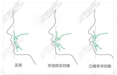 突嘴牙齿矫正对象及手术对象对比