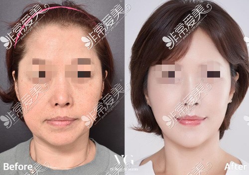 韩国VG百利酷整形医院拉皮手术前后对比照