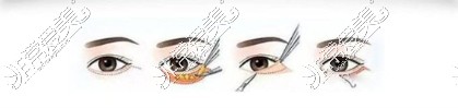 常州美贝尔外切祛眼袋手术方式