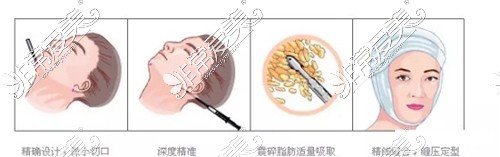 面部吸脂手术流程