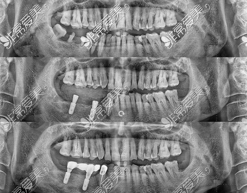 種植牙前后對(duì)比