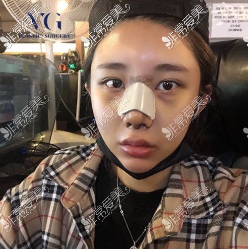 韩国VG百利酷整形隆鼻术后三天