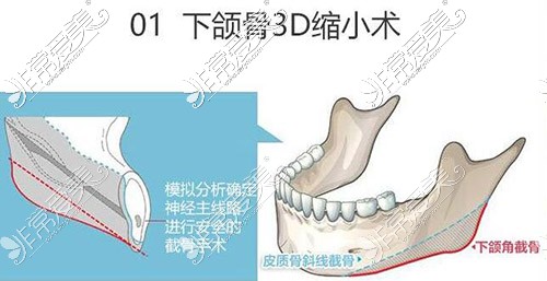 上海时光整形外科3D下颌角手术