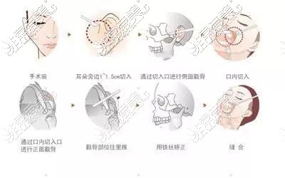 顴骨整形過(guò)程