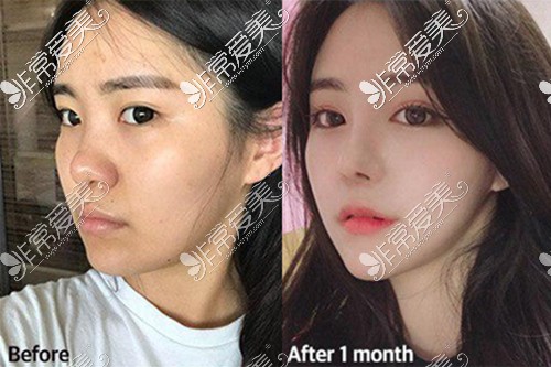 韩国鼻修复医院哪家好？韩国VG百利酷隆鼻技术怎么样？