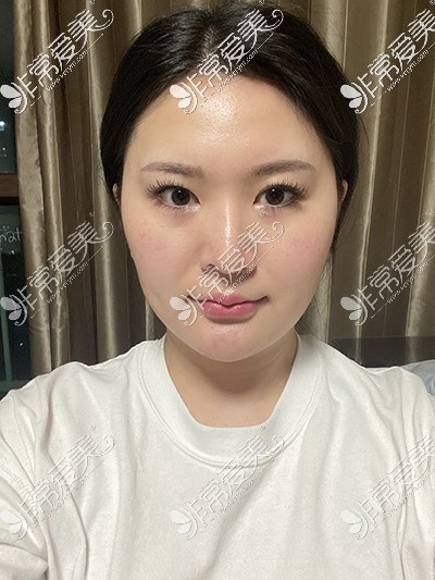 韩国优雅人隆鼻效果图