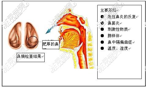 鼻炎发病原因