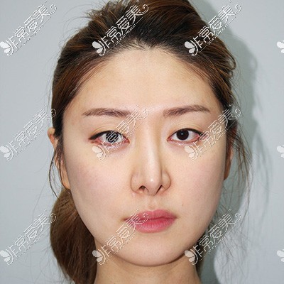 韩国现代美学鼻修复术前