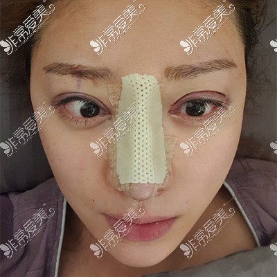 韩国现代美学鼻修复术后2天