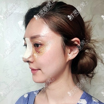 韩国现代美学鼻修复术后7天照片