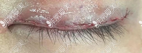 眼睑缘切开双眼皮
