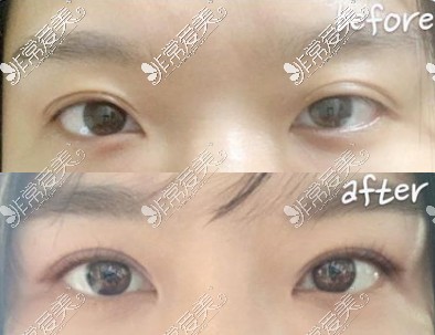 双眼皮不对称修复