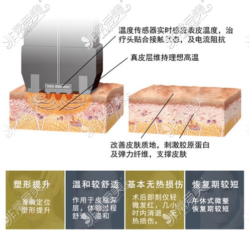 韩国inmode多久做一次?从原理到效果对比inmode和热玛吉哪个好!