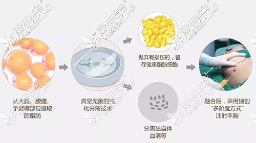 脂肪丰胸手术一般多少钱？抽脂肪丰胸大概要用多少钱？