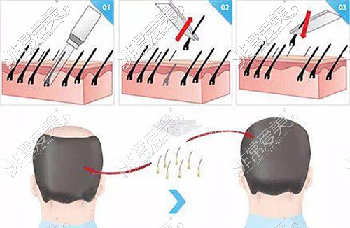 植发过程