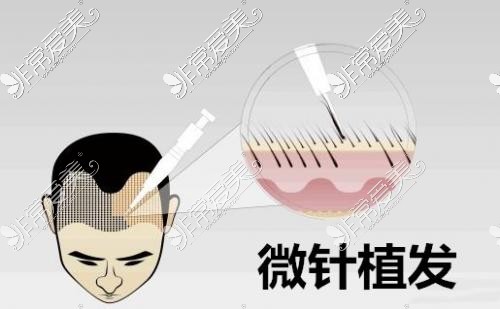 微针植发方法展示图