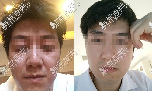 西安绿港医疗美容整形男士面部改善对比