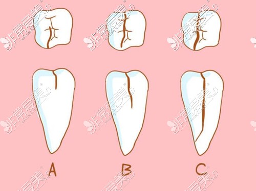牙齿裂了不同程度图