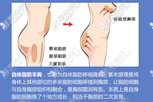 自体脂肪隆胸操作示意图