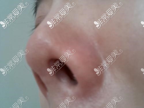 隆鼻挛缩要取出假体修复吗?韩国出名鼻挛缩修复医生有几位?