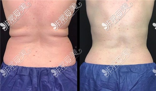 腰腹吸脂对比图 腰腹吸脂对比图