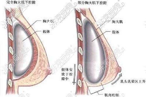 假體隆胸植入方式