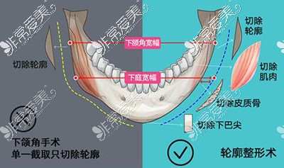 下颌角磨骨手术