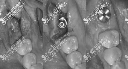 种植牙手术后变化