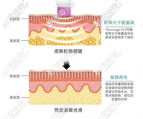 做热玛吉会痛吗？到底有多疼？一点疼痛都没有正常吗？