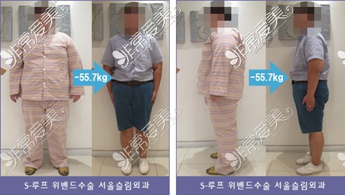 韩国首尔slim外科医院袖状胃手术效果图