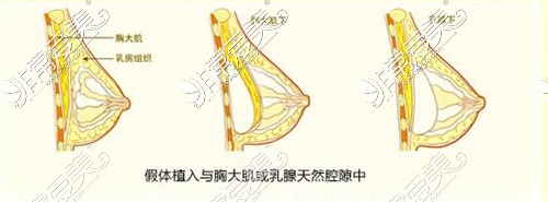 假體隆胸手術(shù)方法展示