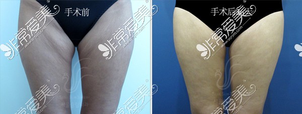 韩国首尔slim外科医院大腿内侧赘皮整形效果图