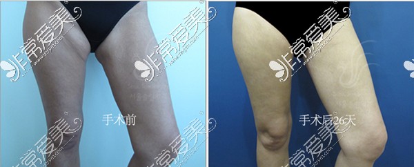 韩国首尔slim外科医院大腿赘皮整形术前后对比图