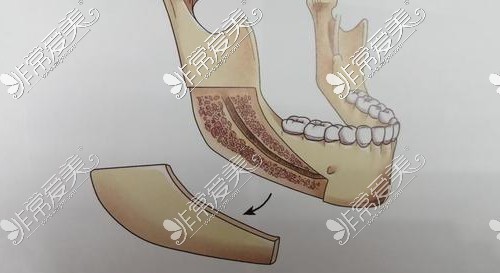 深圳下颌角磨骨手术多少钱?揭秘各种下颌角术式价格明细！