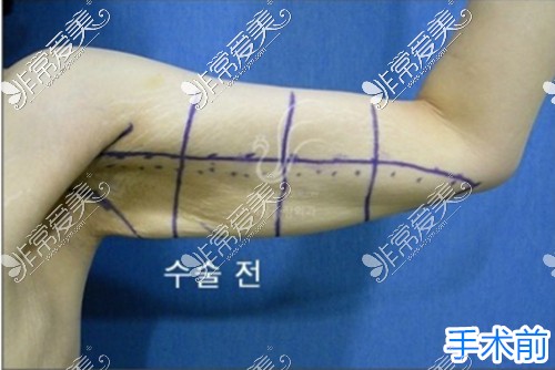 手臂赘皮切除手术前图片