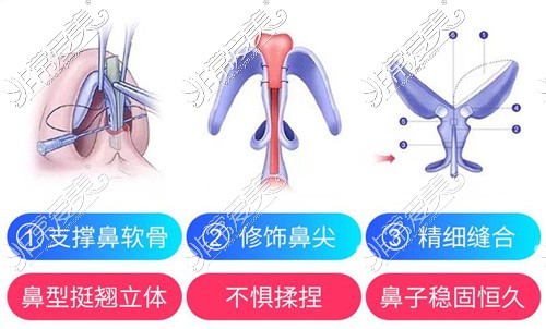 佛山哪家医院做肋骨鼻好?3万块做肋骨鼻价格贵不贵?