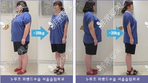 韩国slim外科袖状胃手术前后对比照