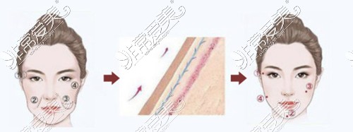 東莞天后整形醫(yī)院埋線提升