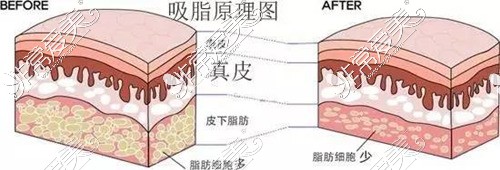 什么人适合做吸脂？什么人不能吸脂？吸脂后都要注意哪些