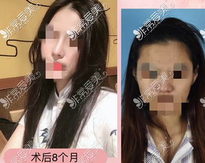 昆明博美隆鼻效果怎么样贵不贵?求美者反馈隆鼻都找博美好!