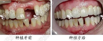 人工种植牙改善效果