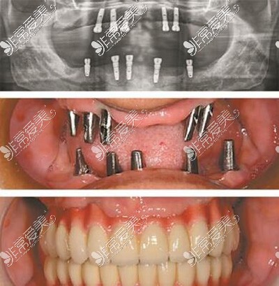 全口种植牙改善对比