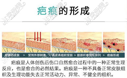 疤痕是如何形成的