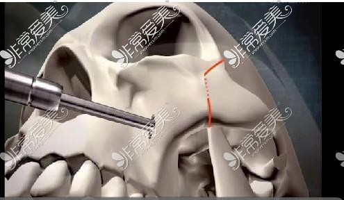 颧骨截骨示意图