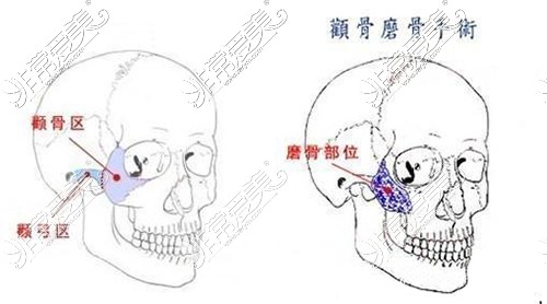 顴骨磨骨手術(shù)